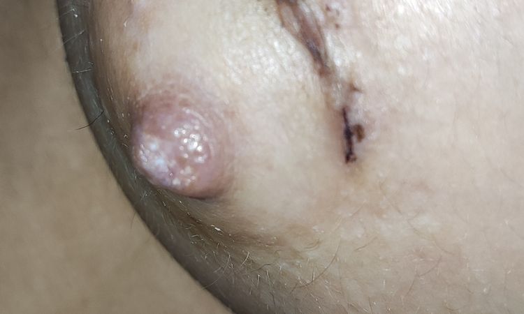 Están evolucionando bien las cicatrices de mis areolas? - 54079