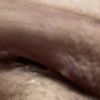 ¿Los masajes arruinaron mi recuperación de Abdominoplastia?