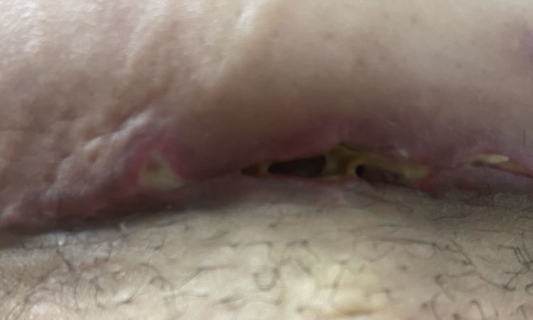 ¿Los masajes arruinaron mi recuperación de Abdominoplastia? - 54900
