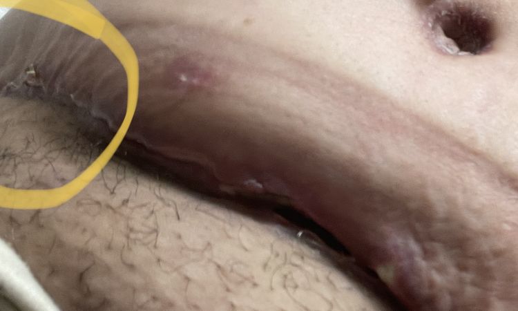 ¿Los masajes arruinaron mi recuperación de Abdominoplastia? - 54902