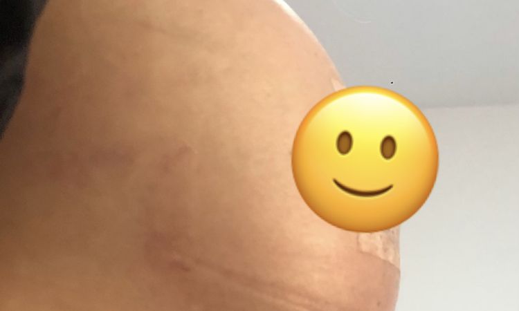 Hundimiento en seno después de mamoplastia de aumento - 56538