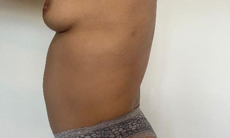 Corregir mala cicatrización y abdomen abultado por abdominoplastia - 56960