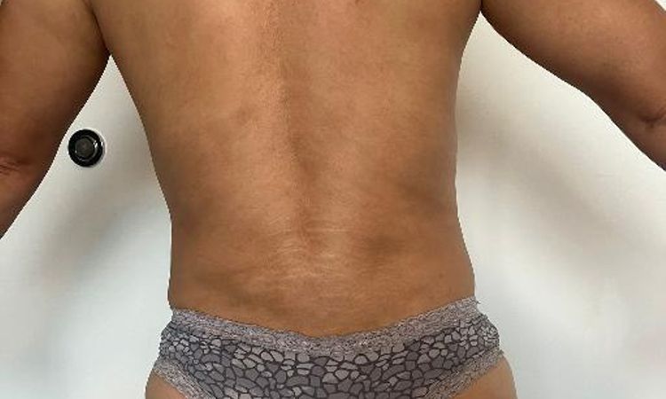Corregir mala cicatrización y abdomen abultado por abdominoplastia - 56961