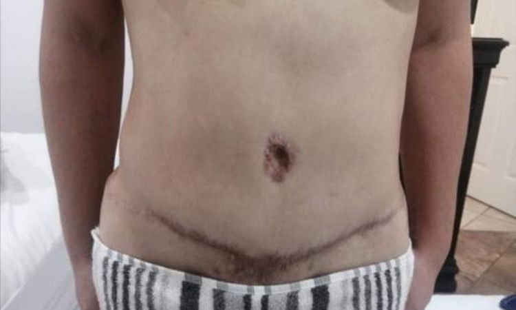 Corregir mala cicatrización y abdomen abultado por abdominoplastia - 56962