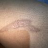 Tatuar cicatriz por quemadura a los 3 meses