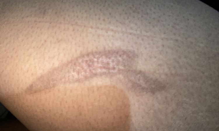 Tatuar cicatriz por quemadura a los 3 meses - 57848