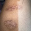 Tatuar cicatriz por quemadura a los 3 meses