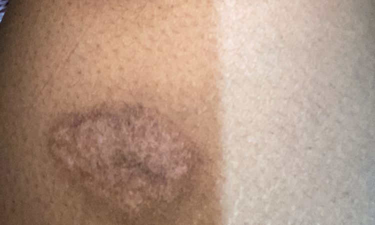 Tatuar cicatriz por quemadura a los 3 meses - 57849