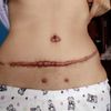 queloide por abdominoplastia