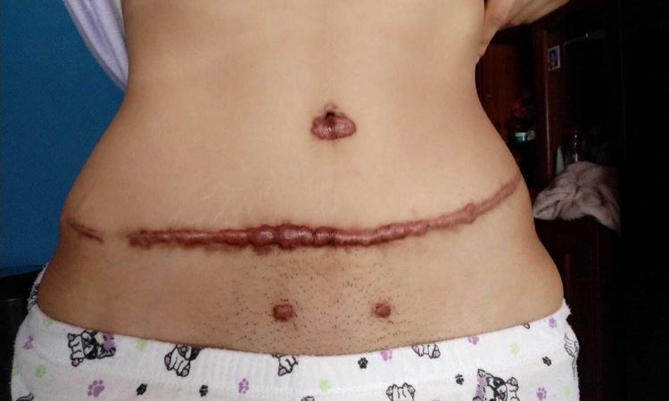 queloide por abdominoplastia - 58491