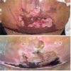 Acelerar cura tras piel necrosada por Abdominoplastia