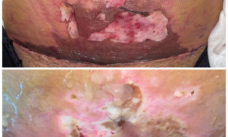 Acelerar cura tras piel necrosada por Abdominoplastia - 58572