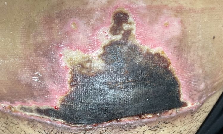 Acelerar cura tras piel necrosada por Abdominoplastia - 58573