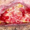 Acelerar cura tras piel necrosada por Abdominoplastia