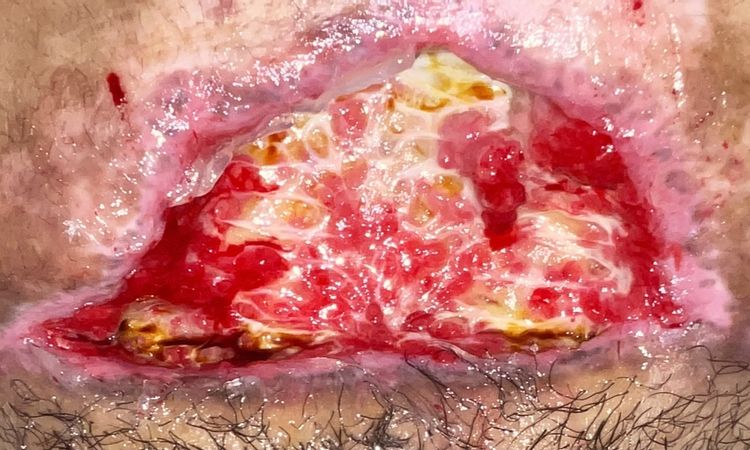 Acelerar cura tras piel necrosada por Abdominoplastia - 58574