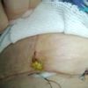 Mastopexia herida puntos