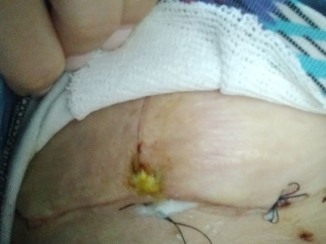 Mastopexia herida puntos