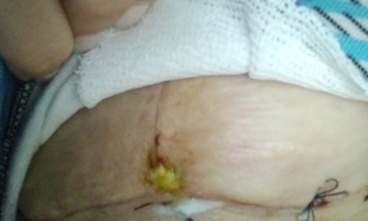 Mastopexia herida puntos - 59184