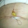 Mastopexia herida puntos