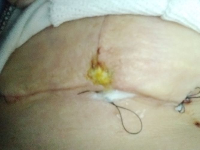 Mastopexia herida puntos