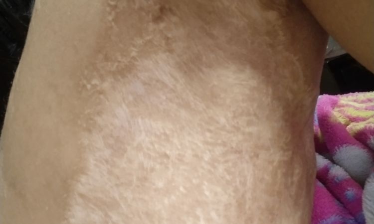 Cicatriz de injerto de piel hace 4 años - 60682