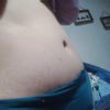 Mucha hinchazón tras 1 año de abdominoplastia