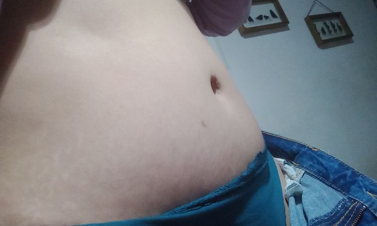 Mucha hinchazón tras 1 año de abdominoplastia - 61589