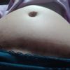 Mucha hinchazón tras 1 año de abdominoplastia