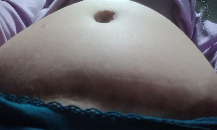 Mucha hinchazón tras 1 año de abdominoplastia - 61590