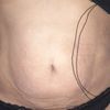 Inflamación después de lipolisis láser