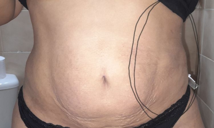 Inflamación después de lipolisis láser - 62742