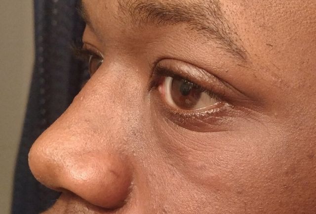 ¿La mejor opción para quitar las bolsas debajo de los ojos?