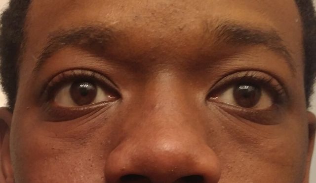 ¿La mejor opción para quitar las bolsas debajo de los ojos?