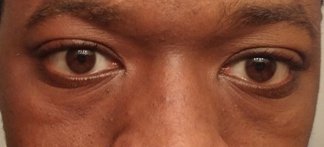 ¿La mejor opción para quitar las bolsas debajo de los ojos?