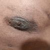Eliminación de cicatriz de pezón y areola después de la cirugía de ginecomastia.