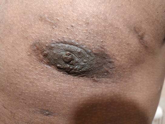 Eliminación de cicatriz de pezón y areola después de la cirugía de ginecomastia. - 65959