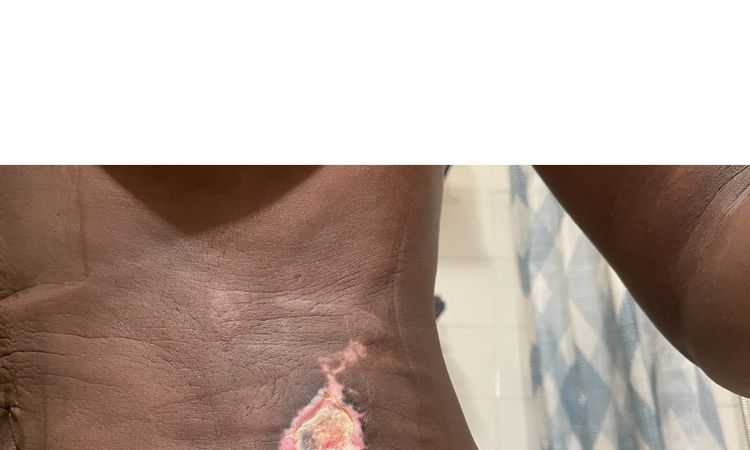 Quemadura con cánula láser por liposucción - 68202