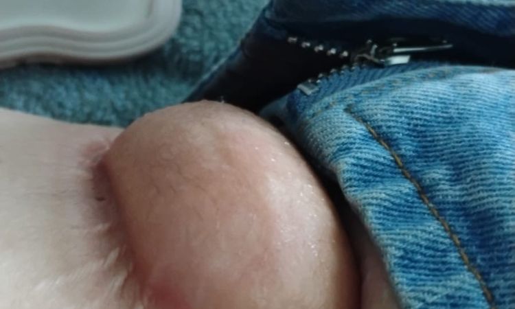 Cómo cuidar una quemadura por criolipolisis - 79628