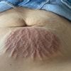 Cómo cuidar una quemadura por criolipolisis