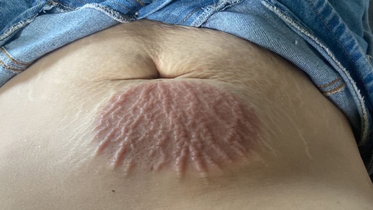Cómo cuidar una quemadura por criolipolisis