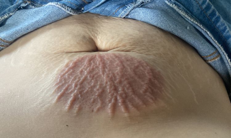 Cómo cuidar una quemadura por criolipolisis - 79629