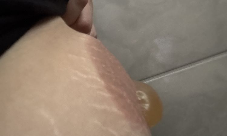 Cómo cuidar una quemadura por criolipolisis - 79631