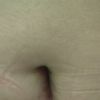 Quitar cicatriz en el abdomen