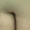 Quitar cicatriz en el abdomen