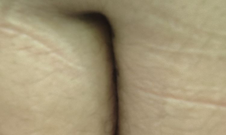 Quitar cicatriz en el abdomen - 81156