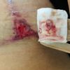 ¿Es normal dehiscencia después de 9 semanas de mamoplastia de reducción?
