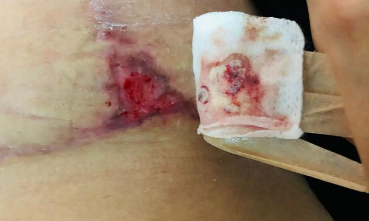 ¿Es normal dehiscencia después de 9 semanas de mamoplastia de reducción? - 81869
