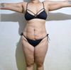 Tratamiento más recomendable para una piel con flacidez