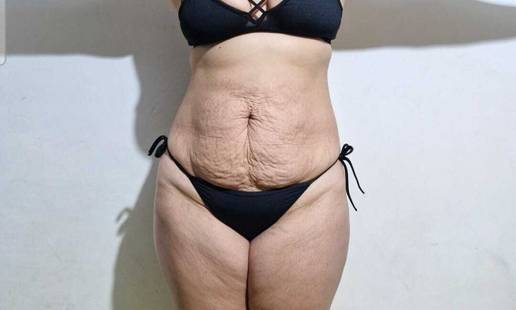 Tratamiento más recomendable para una piel con flacidez - 82402