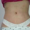 Tratamiento para las estrias y flacidez en el abdomen
